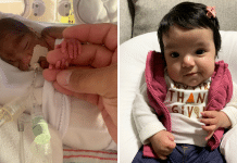 (left) premature baby in ICU (right) same baby weeks later ay home